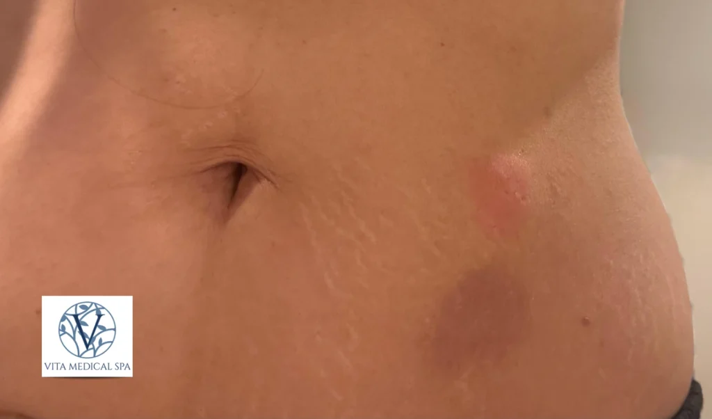 Common Injection Site Reactions